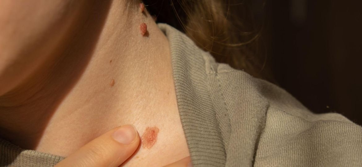 Signs That You May Need Mohs Surgery