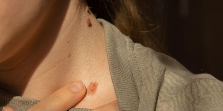 Signs That You May Need Mohs Surgery
