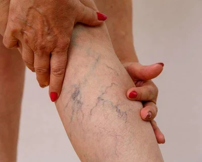 3 Changes to Improve Varicose Veins