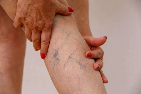 3 Changes to Improve Varicose Veins