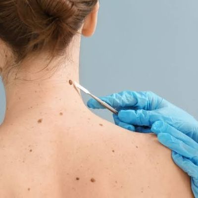 Recognizing Basal Cell Carcinoma