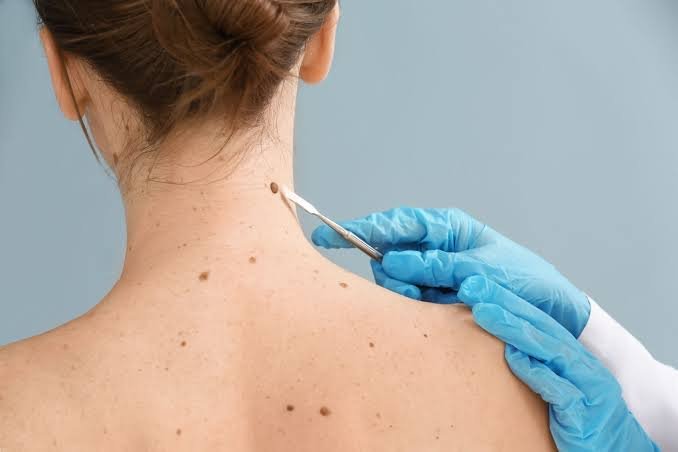 Recognizing Basal Cell Carcinoma