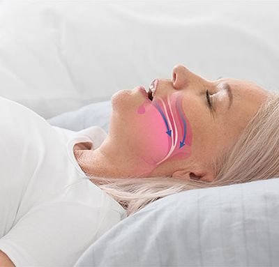 The Role of a Snoring Doctor in Sleep Apnea Treatment