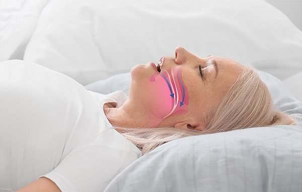 The Role of a Snoring Doctor in Sleep Apnea Treatment