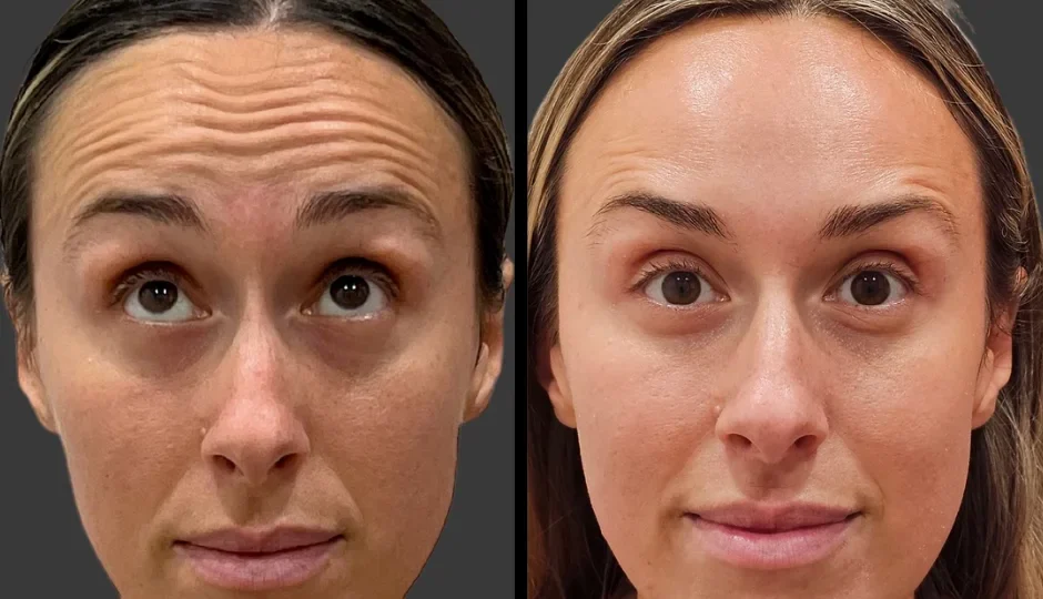 What to Expect Before and After Botox Treatment