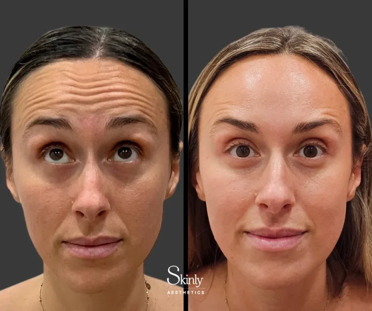 What to Expect Before and After Botox Treatment