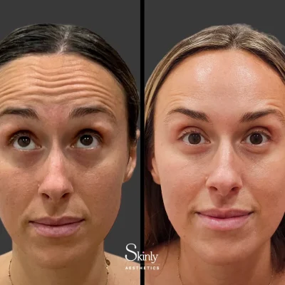 What to Expect Before and After Botox Treatment