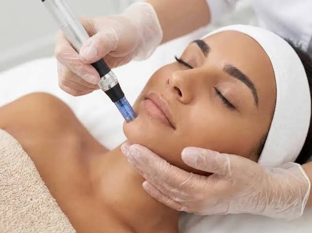 What to Expect During Your first Microneedling Appointment