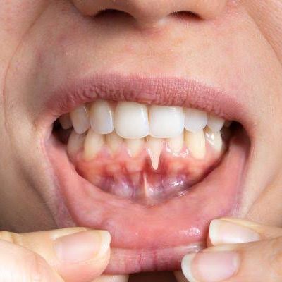 When To Consult a Periodontist for Gum Issues