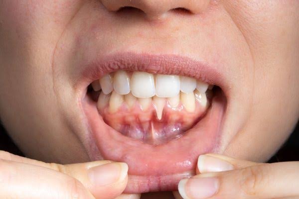 When To Consult a Periodontist for Gum Issues