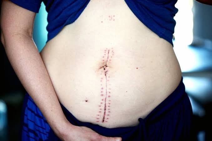 Enhancing Your Natural Beauty Through Abdominal Wall Reconstruction
