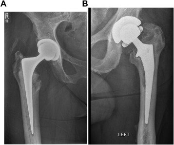 Factors Influencing the Decision for Hip Replacement