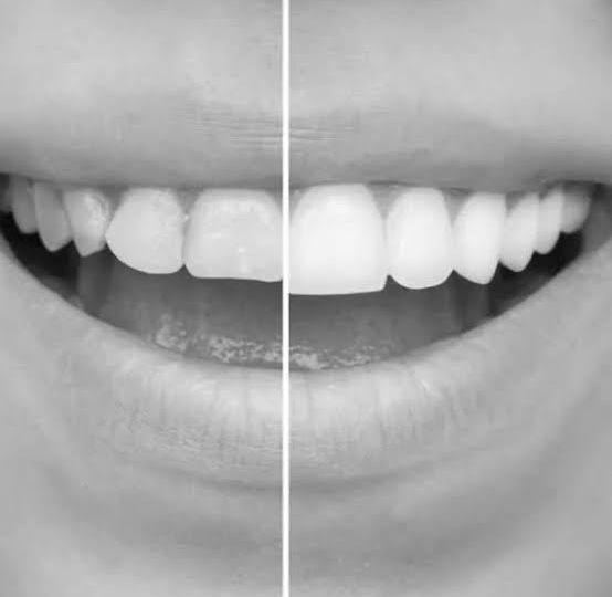 How Veneers Support Overall Oral Health