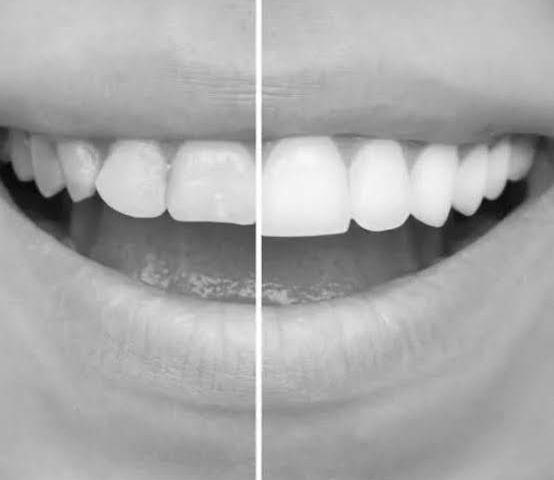 How Veneers Support Overall Oral Health