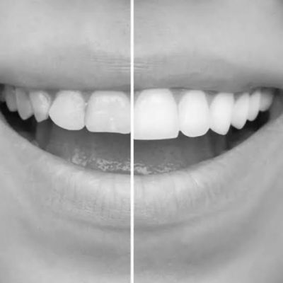 How Veneers Support Overall Oral Health