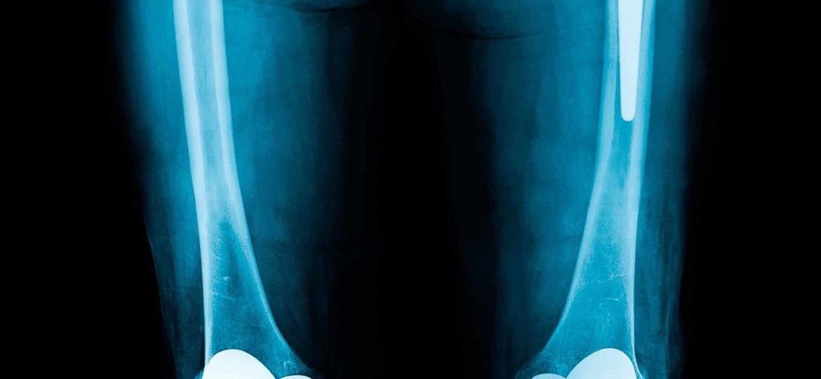 Knowing When Doctors Recommend Total Joint Replacement Surgery