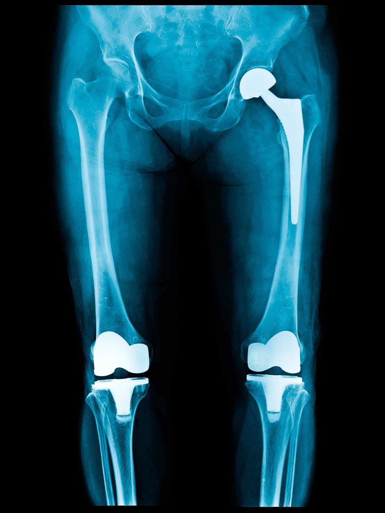 Knowing When Doctors Recommend Total Joint Replacement Surgery