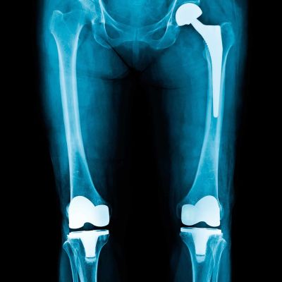 Knowing When Doctors Recommend Total Joint Replacement Surgery