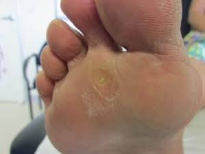 Recognizing the Symptoms of Athlete’s Foot