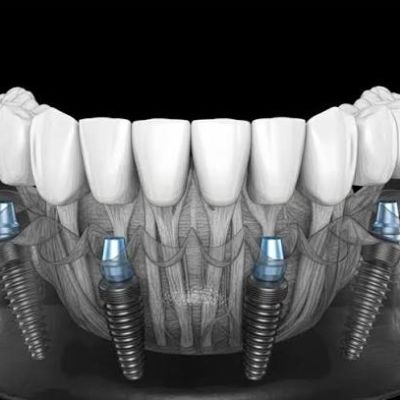 The Advantages of Choosing All-On-4 for Immediate Functionality
