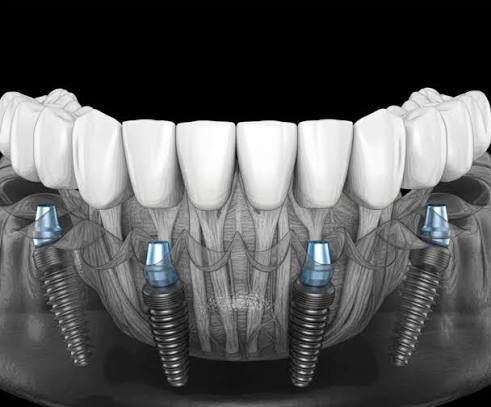 The Advantages of Choosing All-On-4 for Immediate Functionality
