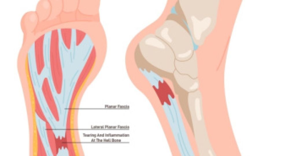 The Connection Between Plantar Fasciitis and Running