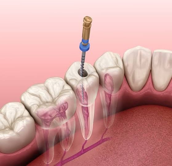 Understanding What a Root Canal Is