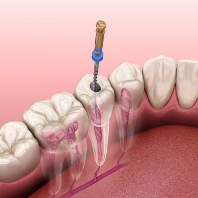 Understanding What a Root Canal Is