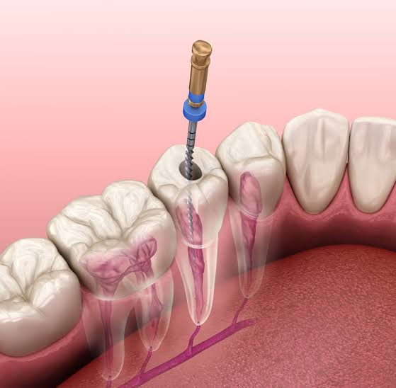 Understanding What a Root Canal Is