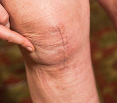 Understanding the Different Types of Arthritis and Their Impact on Daily Life